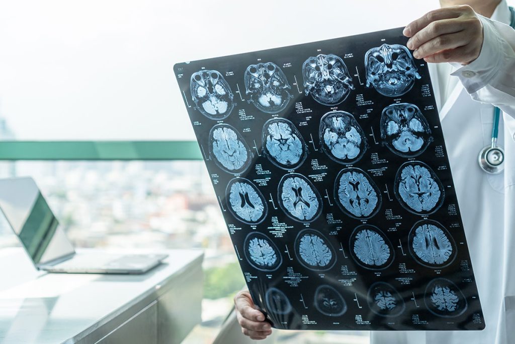 Read: Estimates of Diagnosed Dementia Prevalence and Incidence Among Diverse Beneficiaries in Traditional Medicare and Medicare Advantage