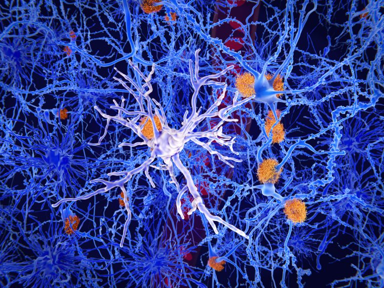Read: Access to Disease-Modifying Alzheimer’s Therapies: Addressing Possible Challenges Using Innovative Payment Models