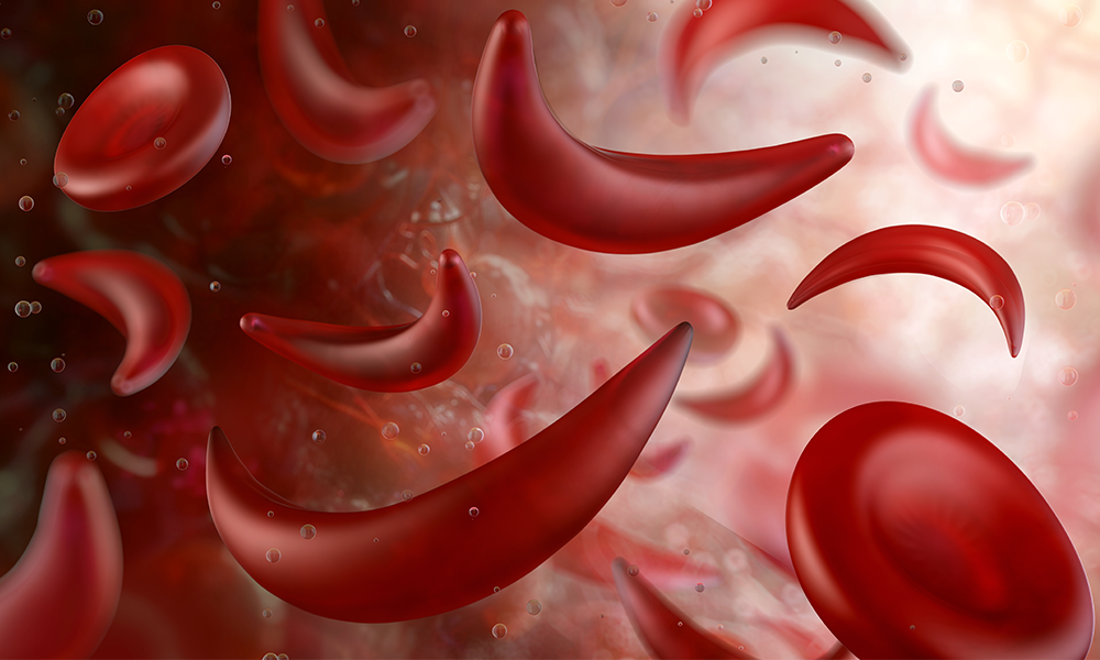 Read: Cost-Effectiveness of Gene Therapy for Sickle Cell Disease in Uganda: Tailoring High-Income Evidence to Uganda’s Context